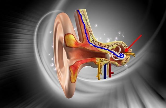 simpukan-implant2